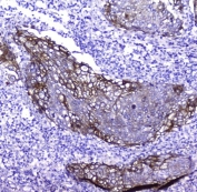 IHC testing of FFEP human lung cancer tissue with Periplakin antibody. Required HIER: steam section in pH8 EDTA for 20 min and allow to cool prior to testing.