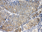 IHC testing of FFPE human lung cancer tissue with TECTA antibody at 1ug/ml. Required HIER: steam section in pH6 citrate buffer for 20 min and allow to cool prior to testing.