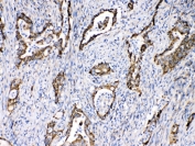 IHC testing of FFPE human intestinal cancer tissue with TECTA antibody at 1ug/ml. Required HIER: steam section in pH6 citrate buffer for 20 min and allow to cool prior to testing.