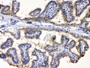 IHC testing of FFPE human thyroid cancer tissue with PDE5A antibody at 1ug/ml. Required HIER: steam section in pH6 citrate buffer for 20 min and allow to cool prior to testing.