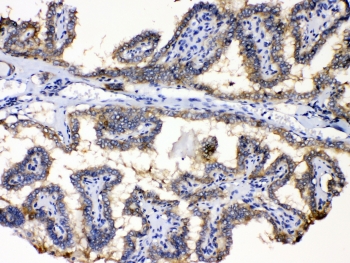 IHC testing of FFPE human thyroid cancer tissue with PDE5A antibody at 1ug/ml. Required HIER: steam se