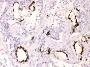 IHC testing of FFPE human lung cancer tissue with AGR2 antibody at 1ug/ml. Required HIER: steam section in pH6 citrate buffer for 20 min and allow to cool prior to testing.