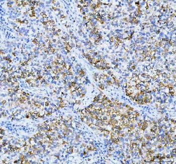 IHC testing of FFPE human lung cancer tissue with AGR2 antibody at 1ug/ml. Required HIER: steam section in pH6 citrate buffer for 20 min and allow to cool prior to testing.