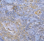 IHC staining of FFPE human laryngeal squamous cell carcinoma tissue with GAPDH antibody. HIER: boil tissue sections in pH8 EDTA for 20 min and allow to cool before testing.