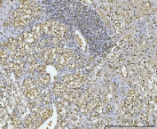 IHC staining of FFPE human renal clear cell carcinoma tissue with GAPDH antibody. HIER: boil tissue sections in pH8 EDTA for 20 min and allow to cool before testing.