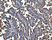 IHC staining of FFPE human ovarian serous cancer tissue with GAPDH antibody. HIER: boil tissue sections in pH8 EDTA for 20 min and allow to cool before testing.