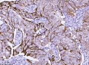 IHC testing of FFPE breast cancer tissue with HER2 antibody. Required HIER: steam section in pH8 EDTA for 20 min and allow to cool prior to testing.