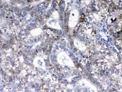 IHC testing of FFPE human liver cancer tissue with HER2 antibody. Required HIER: steam section in pH6 citrate buffer for 20 min and allow to cool prior to testing.