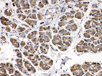 IHC testing of human pancreatic cancer tissue with Alpha Amylase antibody at 0.5ug/ml. Required HIER: steam section in pH6 citrate buffer for 20 min and allow to cool prior to testing.~