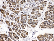 IHC testing of human pancreatic cancer tissue with Alpha Amylase antibody at 0.5ug/ml. Required HIER: steam section in pH6 citrate buffer for 20 min and allow to cool prior to testing.