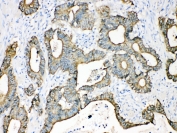 IHC testing of FFPE human intestinal cancer tissue with Cytokeratin 18 antibody at 1ug/ml. Required HIER: steam section in pH6 citrate buffer for 20 min and allow to cool prior to testing.