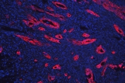 Immunofluorescent staining of FFPE human intestinal cancer with Cytokeratin 18 antibody (red) at 1ug/ml and DAPI nuclear stain (blue). HIER: steam section in pH6 citrate buffer for 20 min.
