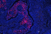 Immunofluorescent staining of FFPE human lung cancer with Cytokeratin 18 antibody (red) at 1ug/ml and DAPI nuclear stain (blue). HIER: steam section in pH6 citrate buffer for 20 min.