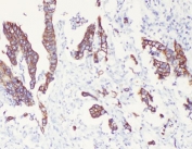 IHC testing of FFPE human intestinal cancer tissue with Cytokeratin 8 antibody at 1ug/ml. Required HIER: steam section in pH6 citrate buffer for 20 min and allow to cool prior to testing.