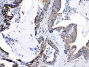 IHC testing of FFPE human intestinal cancer tissue with CRH antibody at 1ug/ml. Required HIER: steam section in pH6 citrate buffer for 20 min and allow to cool prior to testing.