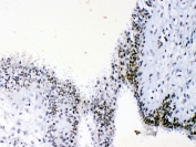 IHC testing of FFPE human breast cancer tissue with HMGB1 antibody at 1ug/ml. Required HIER: steam section in pH6 citrate buffer for 20 min and allow to cool prior to testing.