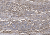 IHC staining of FFPE human colonic adenoma tissue with Annexin IV antibody. HIER: boil tissue sections in pH8 EDTA for 20 min and allow to cool before testing.