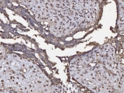 IHC staining of FFPE human breast cancer tissue with Annexin IV antibody. HIER: boil tissue sections in pH8 EDTA for 20 min and allow to cool before testing.