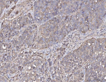 IHC staining of FFPE human liver cancer tissue with Annexin IV antibody. HIER: boil tissue sections in pH8 EDTA for 20 min and allow to cool before testing.
