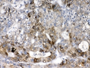 IHC testing of FFPE human liver cancer tissue with CYP2D6 antibody at 1ug/ml. Required HIER: steam section in pH6 citrate buffer for 20 min and allow to cool prior to testing.