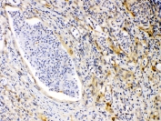 IHC testing of FFPE human intestinal cancer tissue with PRKAR1A antibody at 1ug/ml. Required HIER: steam section in pH6 citrate buffer for 20 min and allow to cool prior to testing.
