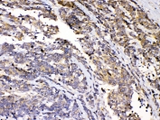 IHC testing of FFPE human lung cancer tissue with PRKAR1A antibody at 1ug/ml. Required HIER: steam section in pH6 citrate buffer for 20 min and allow to cool prior to testing.