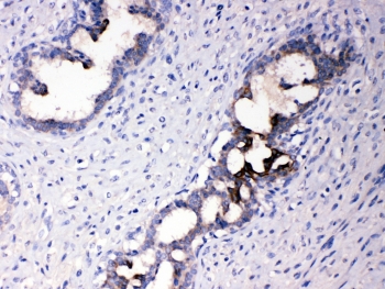 IHC testing of FFPE human breast cancer tissue with ATF6 antibody at 1ug/ml. Required HIER: steam section in pH6 citrate buffer for 20 min and allow to cool prior to testing.~