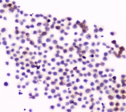 ICC staining of FFPE human U-937 cells with CD11a antibody. HIER: boil tissue sections in pH6, 10mM citrate buffer, for 10-20 min and allow to cool before testing.