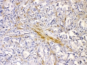 IHC testing of FFPE human prostate cancer tissue with CHRNA5 antibody at 1ug/ml. Required HIER: steam section in pH6 citrate buffer for 20 min and allow to cool prior to testing.