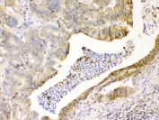 IHC testing of FFPE human intestinal cancer tissue with CD147 antibody at 1ug/ml. Required HIER: steam section in pH6 citrate buffer for 20 min and allow to cool prior to testing.