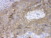 IHC testing of FFPE human lung cancer tissue with CD147 antibody at 1ug/ml. Required HIER: steam section in pH6 citrate buffer for 20 min and allow to cool prior to testing.