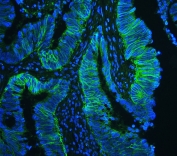 Immunofluorescent staining of FFPE human intestinal cancer with CD147 antibody (green) at 1ug/ml and DAPI nuclear stain (blue). HIER: steam section in pH6 citrate buffer for 20 min.