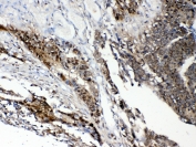 IHC testing of FFPE human intestinal cancer tissue with STAT1 antibody at 1ug/ml. Required HIER: steam section in pH6 citrate buffer for 20 min and allow to cool prior to testing.