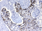 IHC testing of FFPE human intestinal cancer tissue with PI3K p110 antibody at 1ug/ml. Required HIER: steam section in pH6 citrate buffer for 20 min and allow to cool prior to testing.