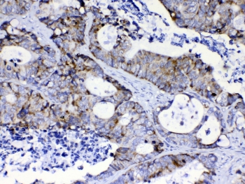 IHC testing of FFPE human lung cancer tissue with PI3K p110 antibody at 1ug/ml. Required HIER: steam section in pH6 citrate buffer for 20 min and allow to cool prior to testing.