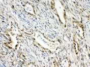 IHC testing of FFPE human intestinal cancer tissue with RanBP1 antibody at 1ug/ml. Required HIER: steam section in pH6 citrate buffer for 20 min and allow to cool prior to testing.