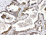 IHC testing of FFPE human lung cancer tissue with RanBP1 antibody at 1ug/ml. Required HIER: steam section in pH6 citrate buffer for 20 min and allow to cool prior to testing.