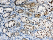 IHC testing of FFPE human stomach cancer tissue with ALDH1A3 antibody at 1ug/ml. Required HIER: steam section in pH6 citrate buffer for 20 min and allow to cool prior to testing.