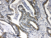 IHC testing of FFPE human intestinal cancer tissue with HSD17B4 antibody at 1ug/ml. Required HIER: steam section in pH6 citrate buffer for 20 min and allow to cool prior to testing.