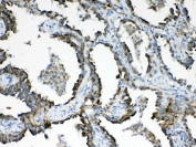 IHC testing of FFPE human lung cancer tissue with HSD17B4 antibody at 1ug/ml. Required HIER: steam section in pH6 citrate buffer for 20 min and allow to cool prior to testing.