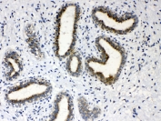 IHC testing of FFPE human breast cancer tissue with HSD17B4 antibody at 1ug/ml. Required HIER: steam section in pH6 citrate buffer for 20 min and allow to cool prior to testing.