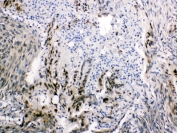 IHC testing of FFPE human intestinal cancer tissue with FABP2 antibody at 1ug/ml. Required HIER: steam section in pH6 citrate buffer for 20 min and allow to cool prior to testing.