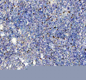 IHC staining of FFPE human tonsil tissue with Interleukin-2 antibody, HRP-labeled secondary and DAB substrate. HIER: boil tissue sections in pH8 EDTA for 20 min and allow to cool before testing.