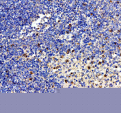 IHC staining of FFPE human spleen tissue with Interleukin-2 antibody, HRP-labeled secondary and DAB substrate. HIER: boil tissue sections in pH8 EDTA for 20 min and allow to cool before testing.