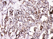 IHC testing of FFPE human breast cancer tissue with ISL1 antibody at 1ug/ml. Required HIER: steam section in pH6 citrate buffer for 20 min and allow to cool prior to testing.