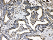 IHC testing of FFPE human intestinal cancer tissue with Beta-2 Microglobulin antibody at 1ug/ml. Required HIER: steam section in pH6 citrate buffer for 20 min and allow to cool prior to testing.