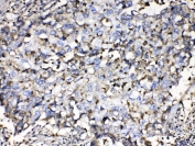 IHC testing of FFPE human lung cancer tissue with Beta-2 Microglobulin antibody at 1ug/ml. Required HIER: steam section in pH6 citrate buffer for 20 min and allow to cool prior to testing.