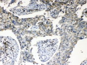 IHC testing of FFPE human lung cancer tissue with RPS6 antibody at 1ug/ml. Required HIER: steam section in pH6 citrate buffer for 20 min and allow to cool prior to testing.