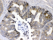 IHC testing of FFPE human intestinal cancer tissue with RPS6 antibody at 1ug/ml. Required HIER: steam section in pH6 citrate buffer for 20 min and allow to cool prior to testing.