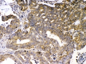 IHC testing of FFPE human intestinal cancer tissue with GAD65 antibody at 1ug/ml. Required HIER: steam section in pH6 citrate buffer for 20 min and allow to cool prior to testing.